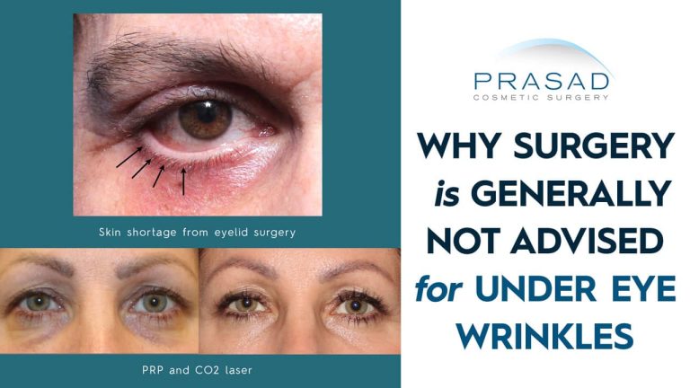 why surgery is generally not advised for under eye wrinkles