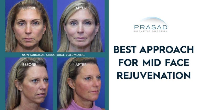 best approach for mid-face rejuvenation