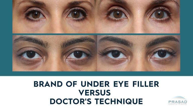 brand of under eye filler versus doctors technique