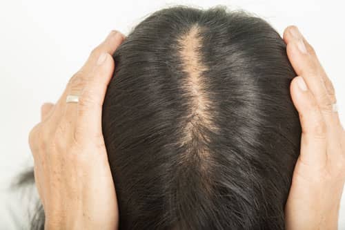 female pattern hair loss sample