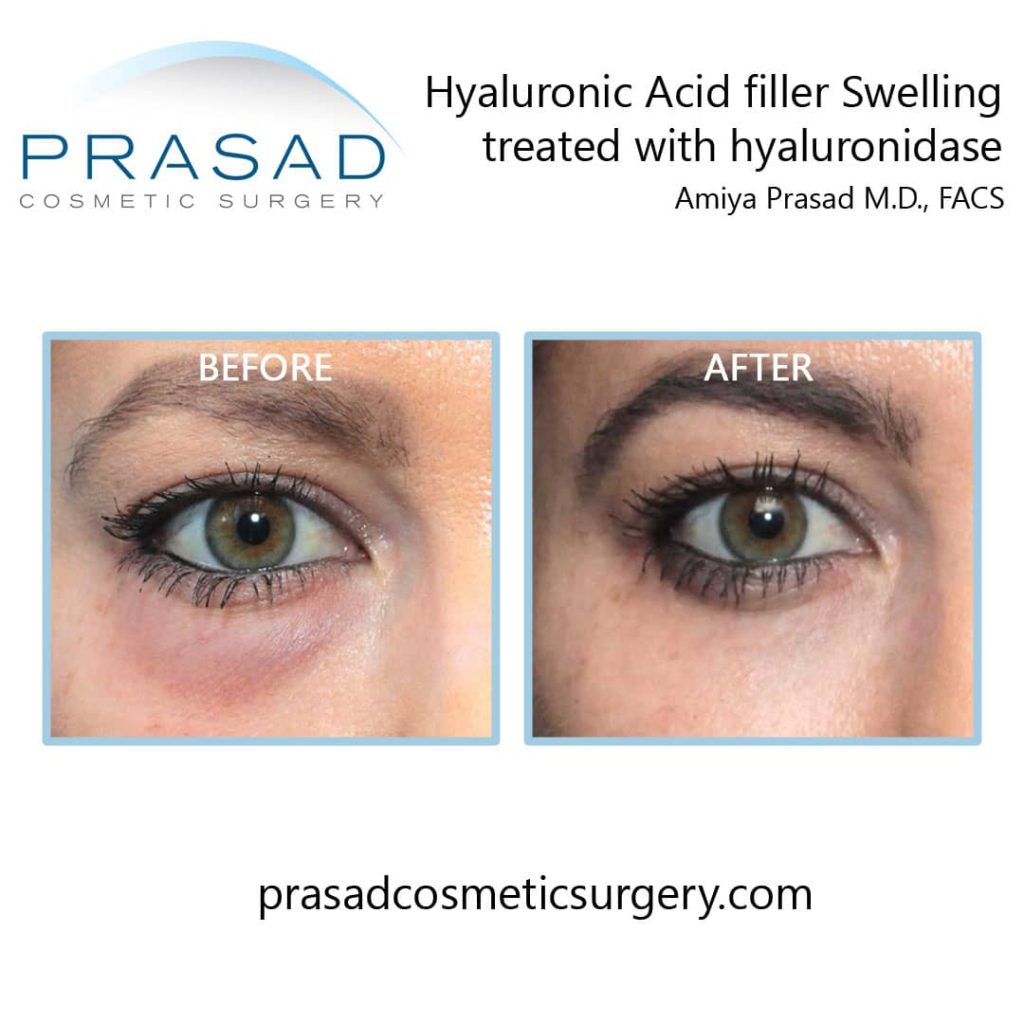 https://prasadcosmeticsurgery.com/wp-content/uploads/2023/02/hyaluronic-acid-filler-right-eye-female-appears-like-under-eye-bag-before-and-after-hyaluronidase-treatment-by-Dr-Amiya-Prasad-1024x1024.jpg