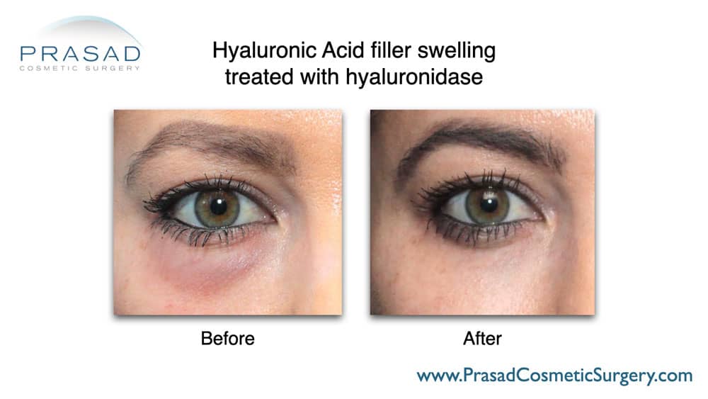 Hyaluronidase treatment before and after