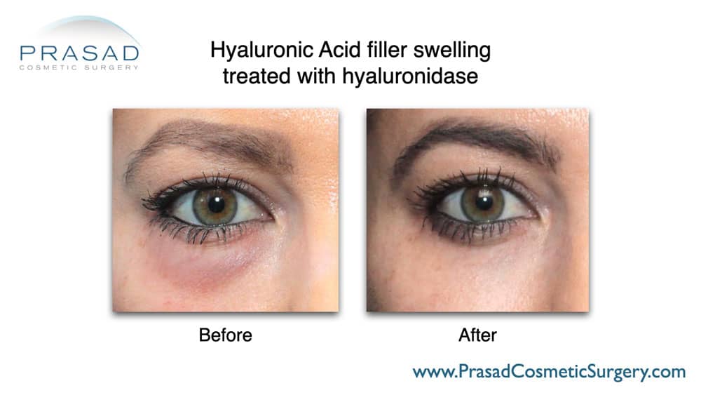 What is the best tear trough filler? | Dr. Prasad Blog