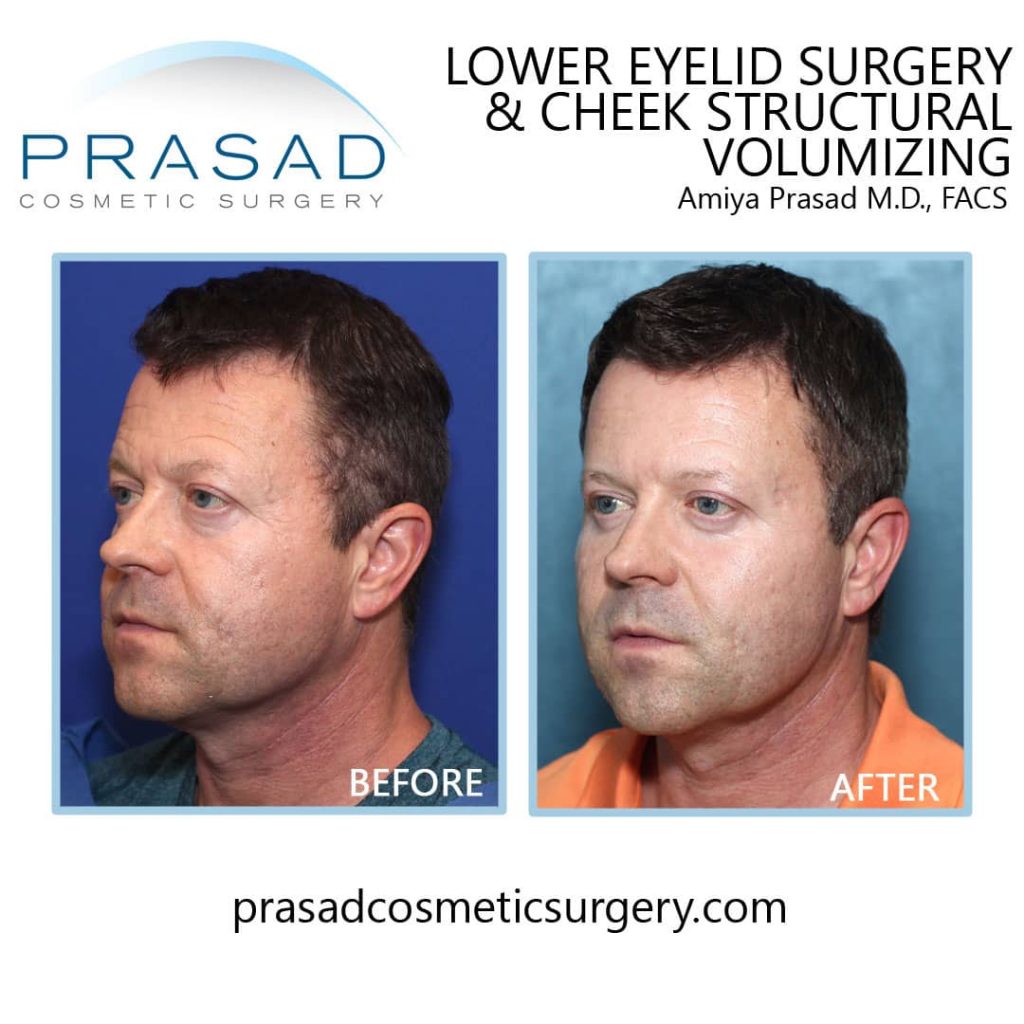 Cheek Augmentation Before and After Photos - Boston Eyelids