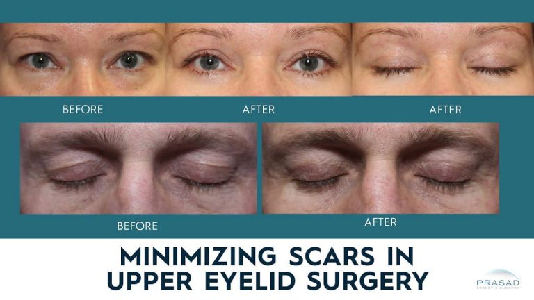 Facelift Surgery And Eyelid Surgery By Dr Amiya Prasad New York 7550