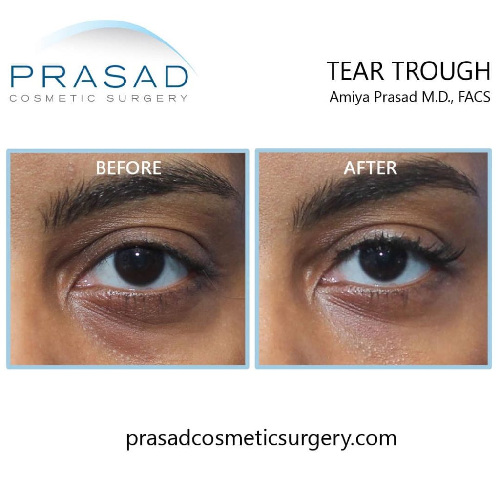 female patient tear trough fillers before and after