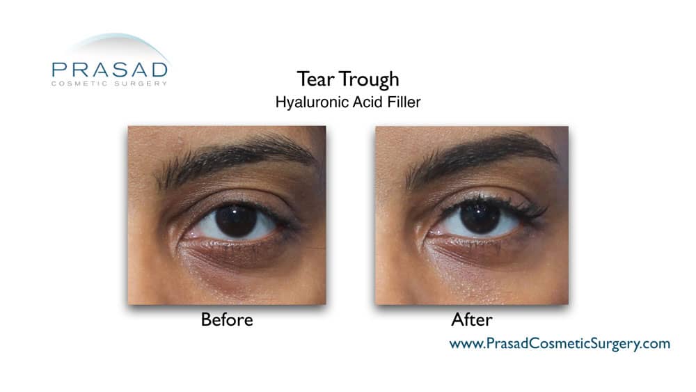 tear trough under eye filler before and after