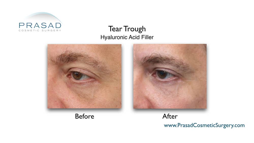 male patient tear trough fillers before and after