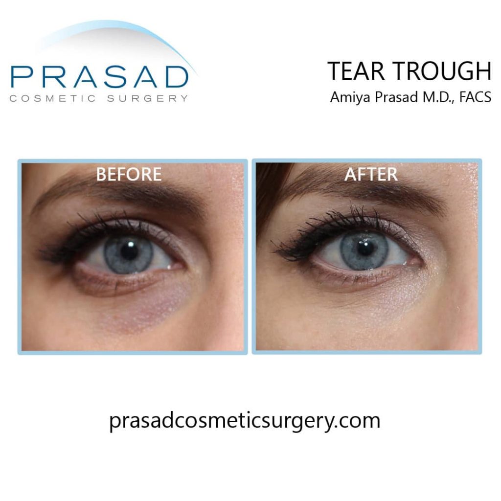 Under Eye Fat Transfer: Possible Complications & Safer Alternative