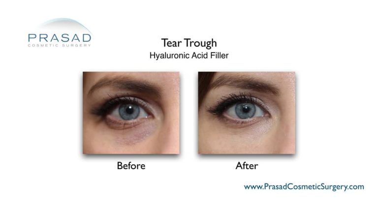 Under Eye Fat Transfer: Possible Complications & Safer Alternative