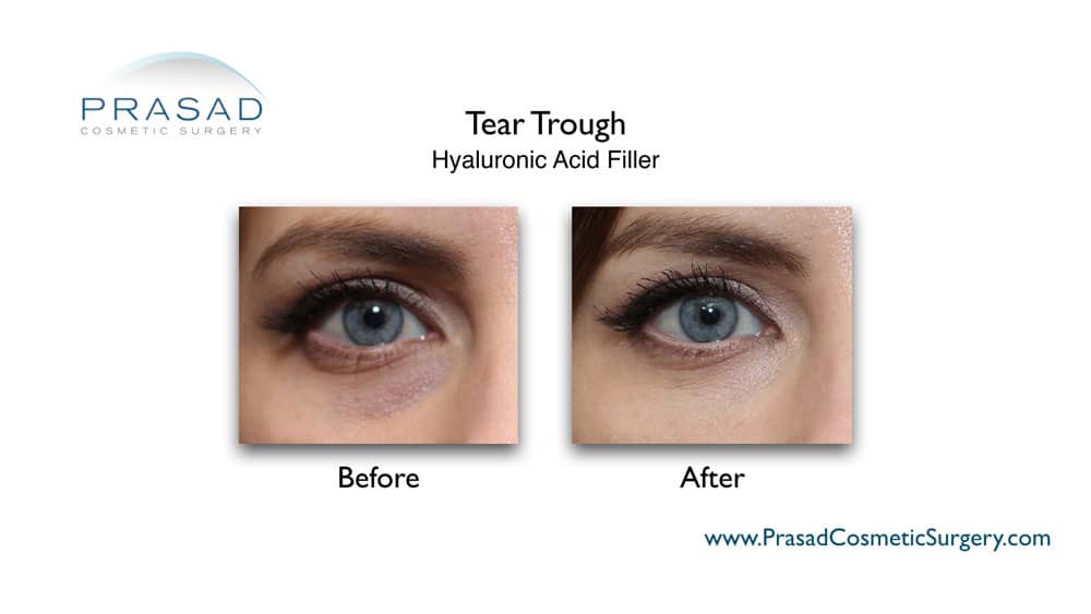 female patient before and after tear trough fillers procedure by Amiya Prasad MD, NYC