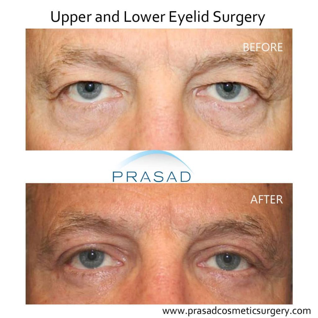 lower and hooded eyelid surgery before and after