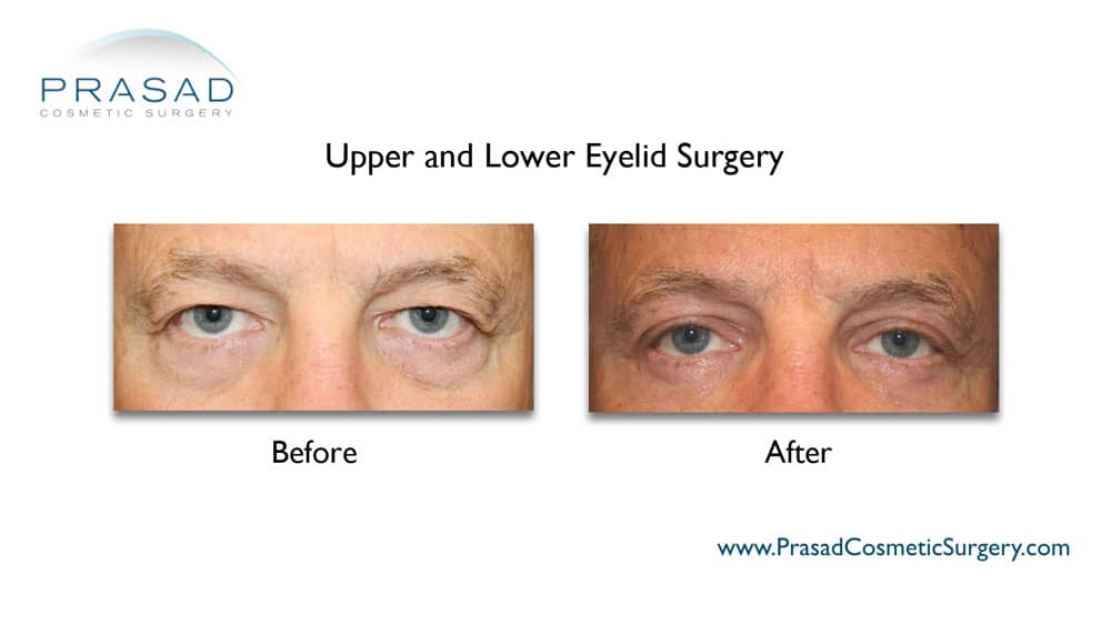 upper and lower blepharoplasty before and after male procedure performed by Dr. Amiya Prasad NYC
