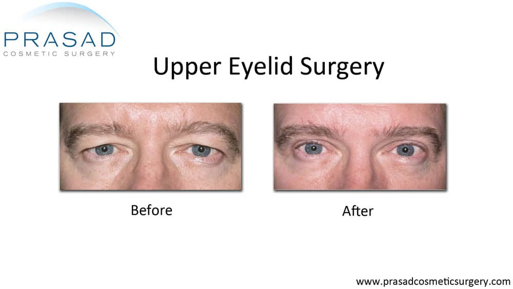 hooded eyelid surgery before and after male patient