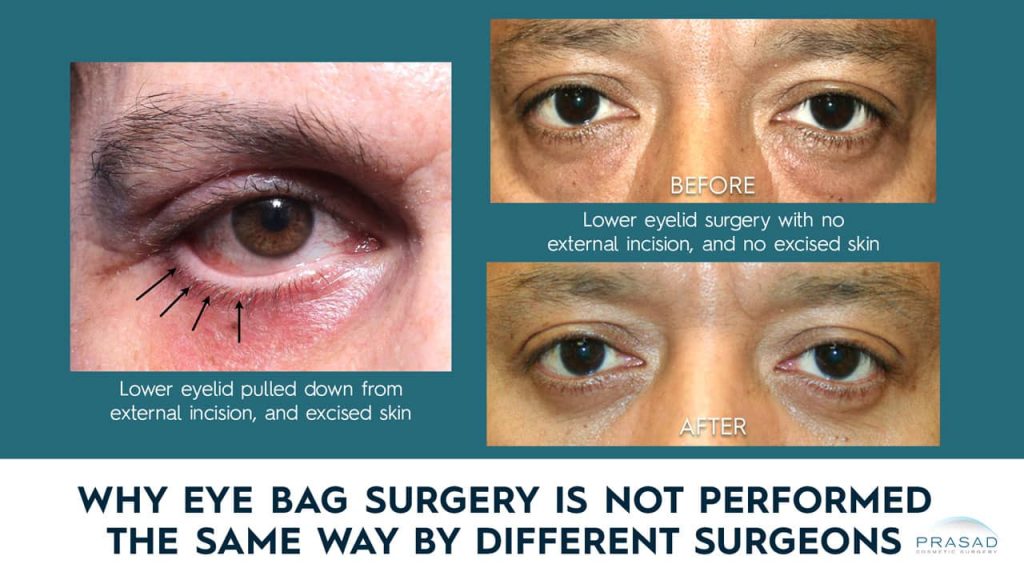 why not all bags under eye surgery is not the same