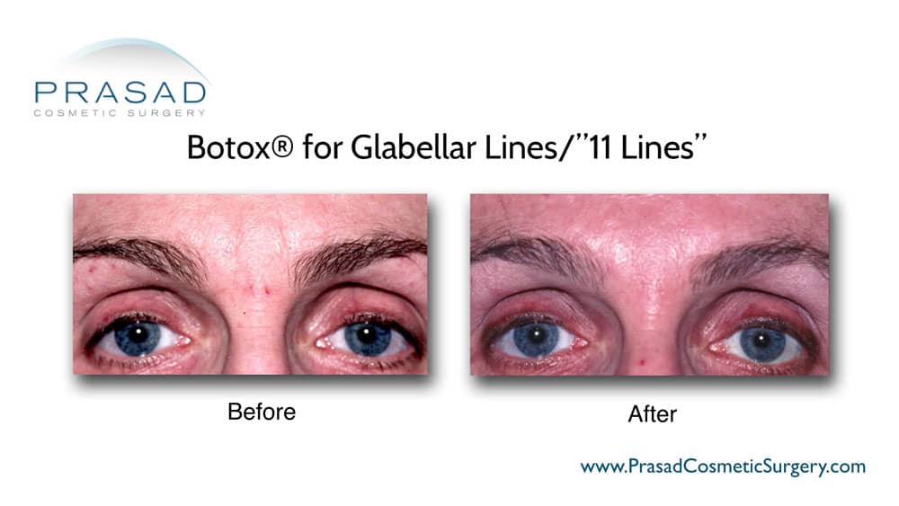 Botox for forehead lines before and after