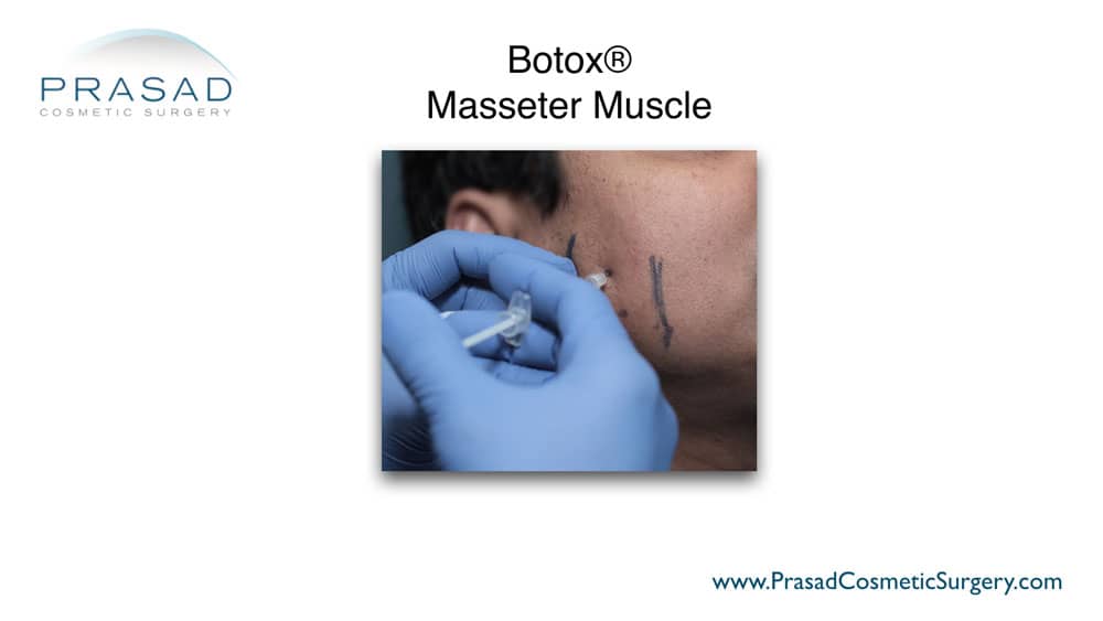 Masseter Botox