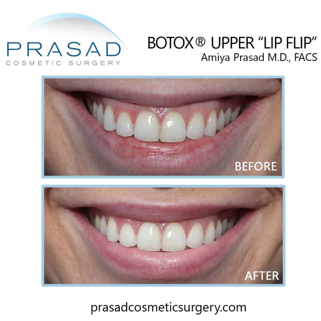 Botox Lip Flip Before and After