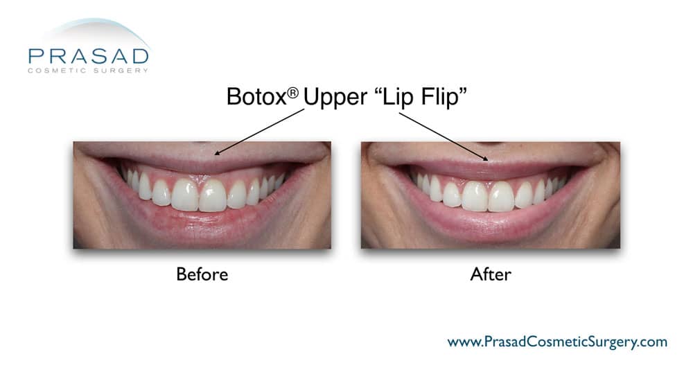 Lip Flip Before and After