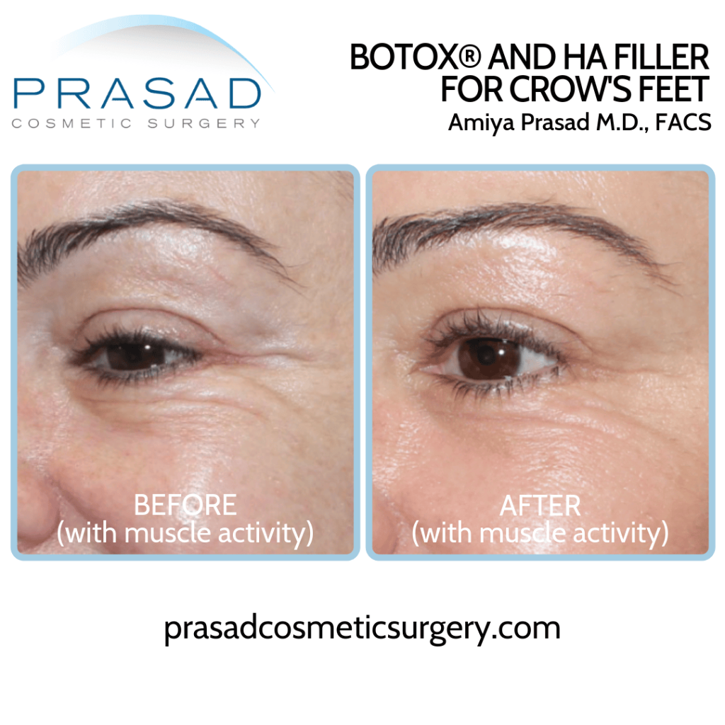 filler and botox before and after crows feet