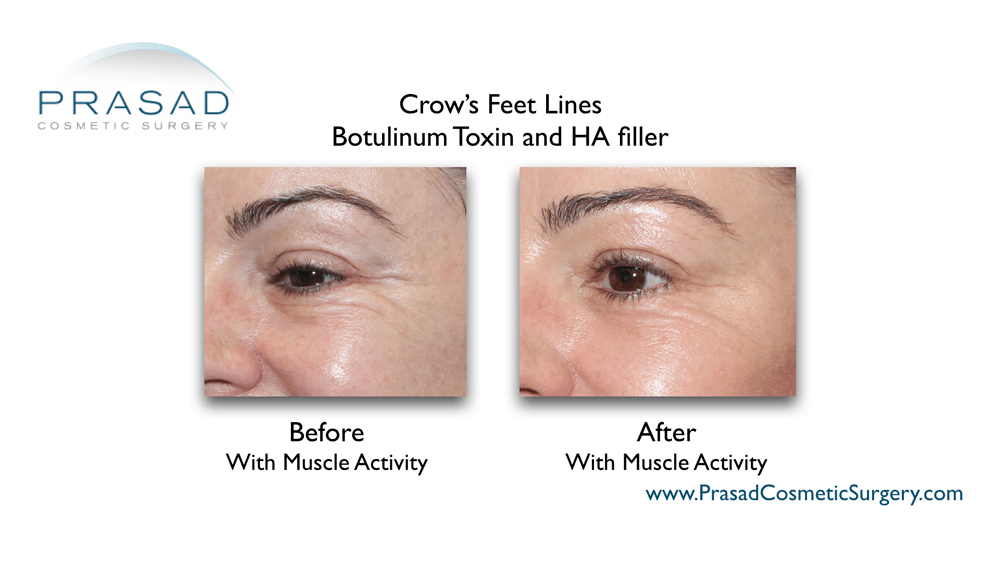 fillers and botox for crows feet before and after