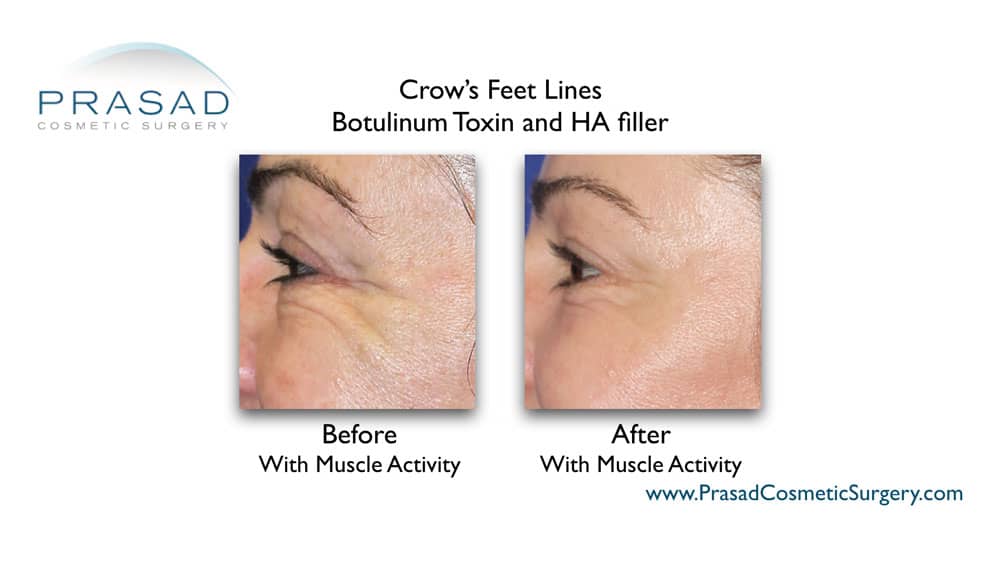 how long does Botox last - filler and Botox before and after