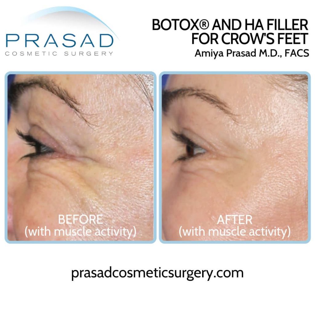 how long does Botox last - botox before and after