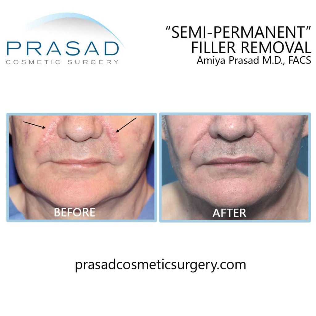 semi-permanent filler removal before and after