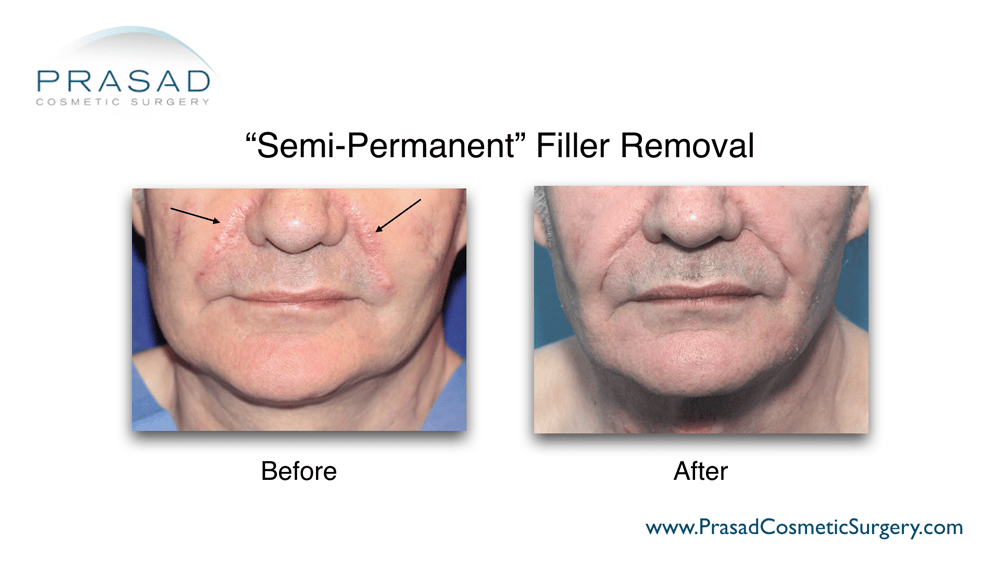 Before and after semi-permanent filler removal