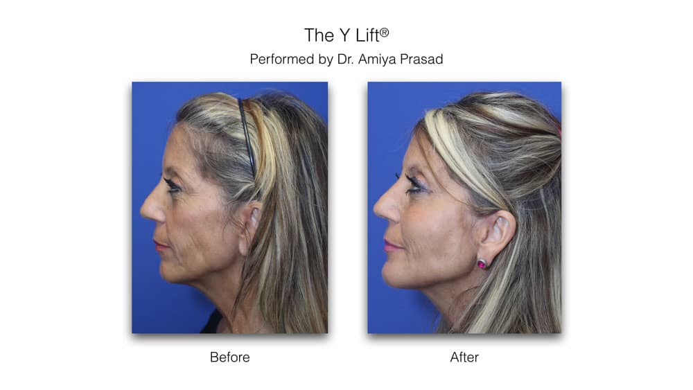 face fillers before and after at Prasad Cosmetic Surgery