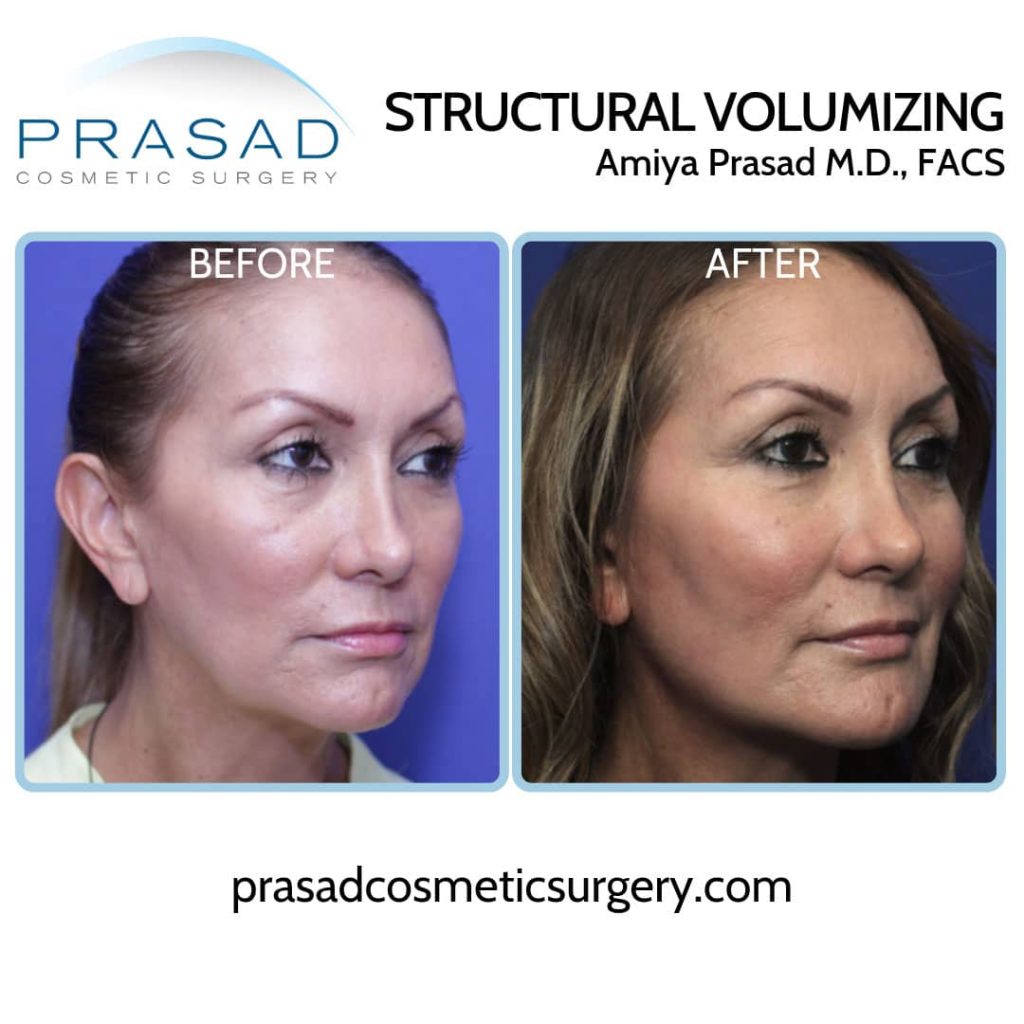 how long do fillers last - non-surgical face lift before and after
