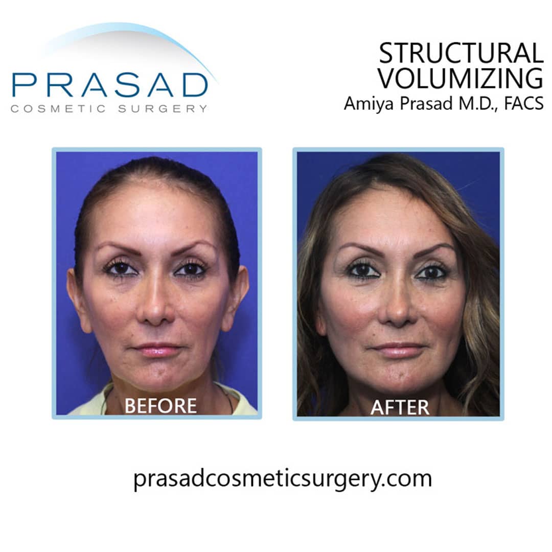 non-surgical facelift before and after