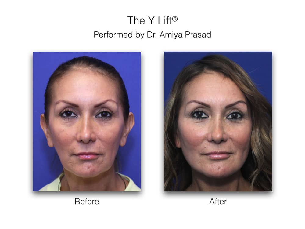 Face Lift Seattle  Face Lift Specialist