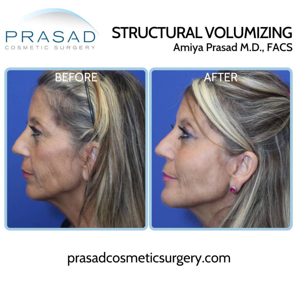 dermal fillers before and after at Prasad Cosmetic Surgery