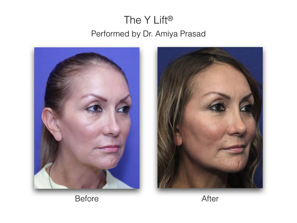 how long do fillers last - dermal face fillers before and after