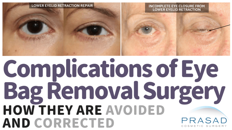 how to avoid eye bag removal surgery risks