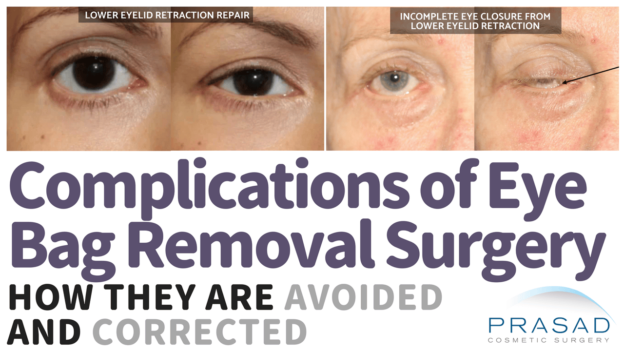 Eye Bag Removal Surgery Procedure Risks Recovery