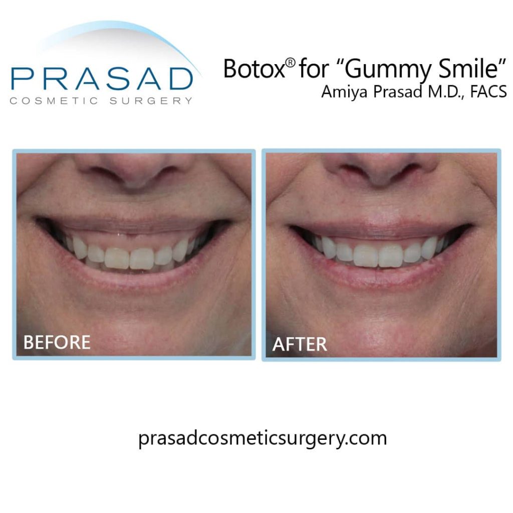 Botox for Gummy Smile before and after