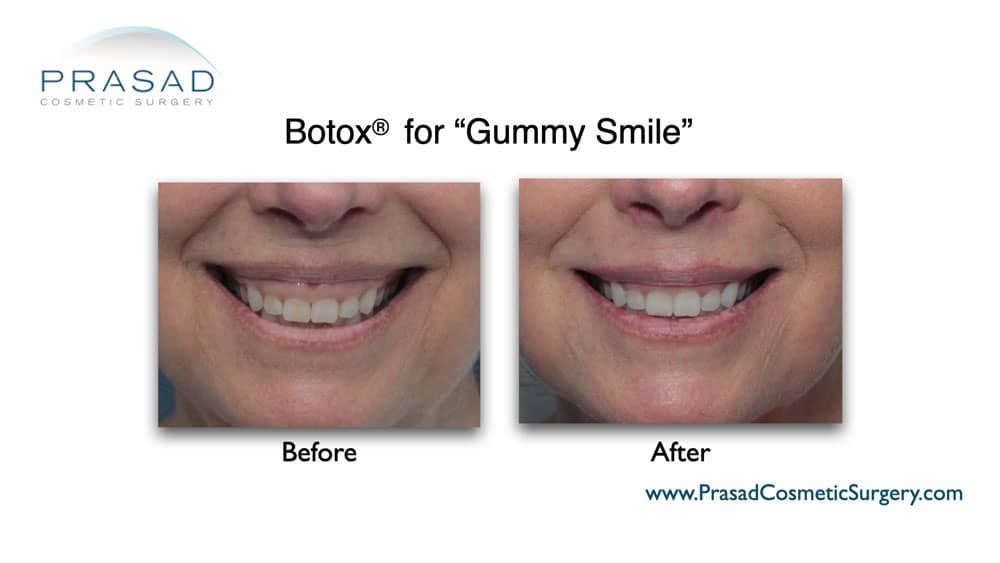 Botox for Gummy Smile