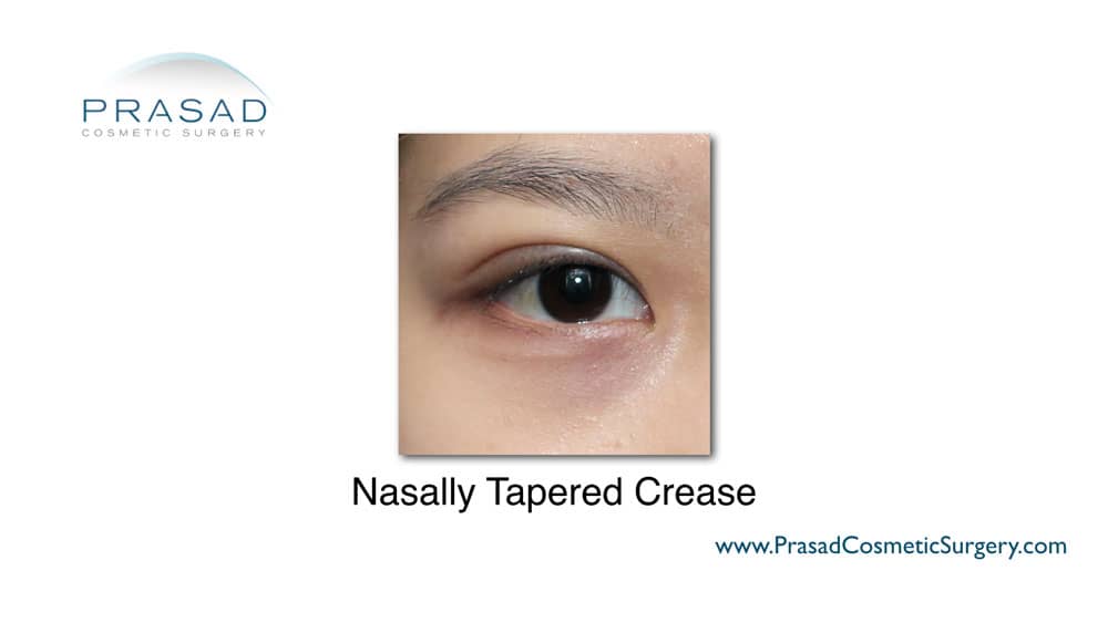 tapered eyelid crease