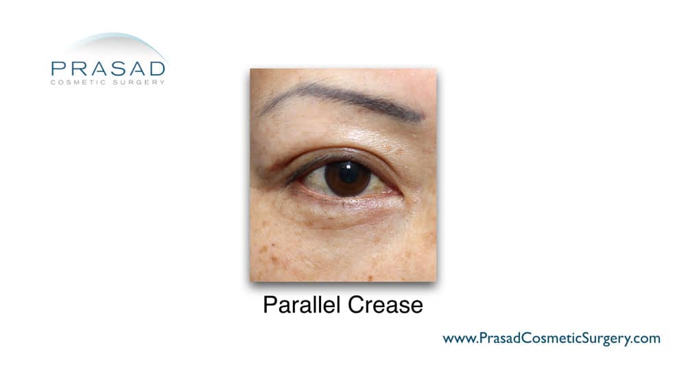 parallel Asian eyelid crease