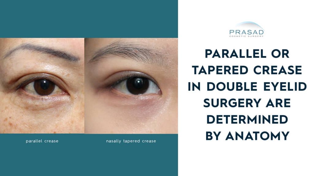 parallel or tapered eyelid crease in Asian eye surgery