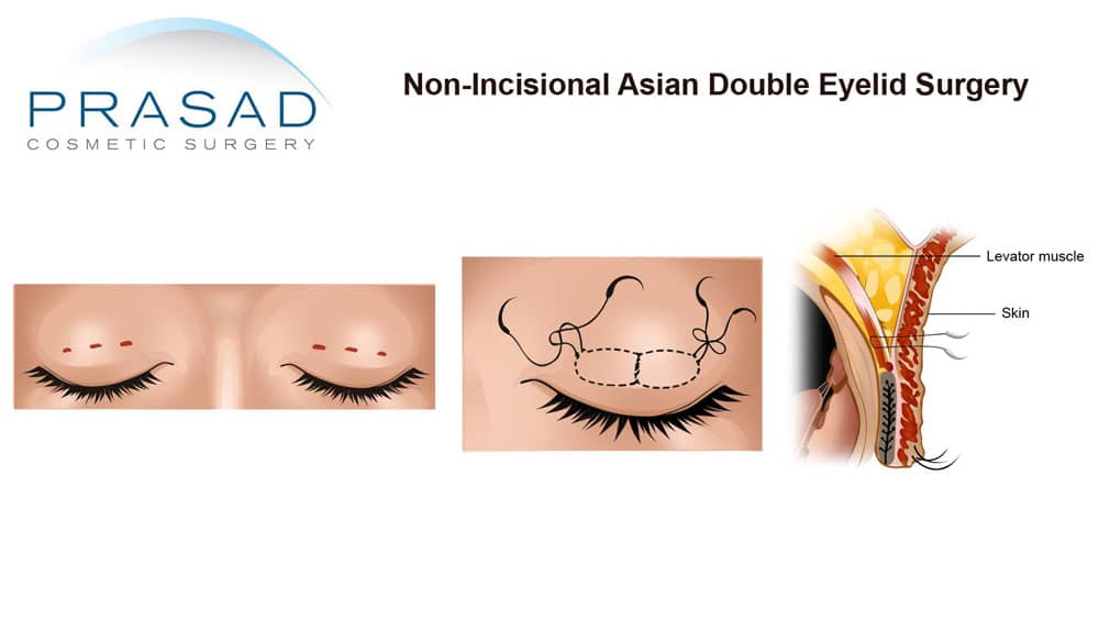 Double eyelid surgery non-incisional suture technique