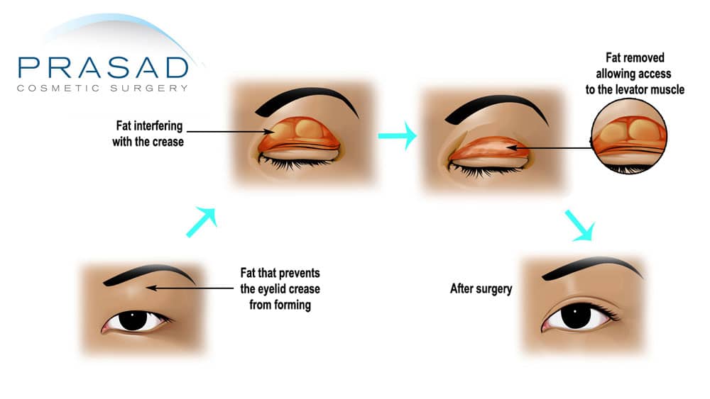 eyelid surgery for Asian eyes - crease creation