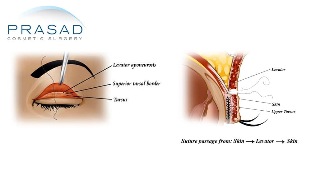 eyelid surgery for Asian eyes - levator skin