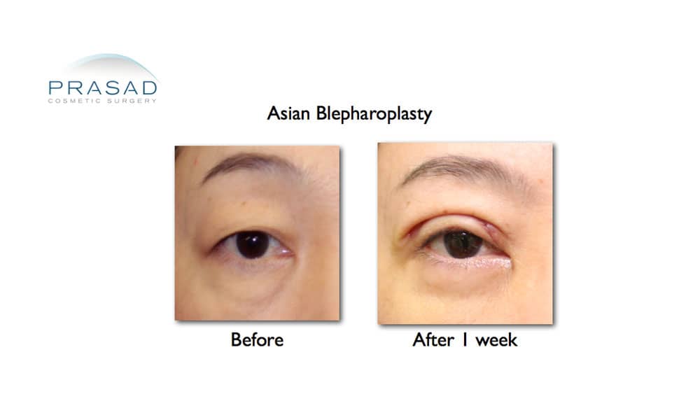 Asian eyelid surgery before and after 1 week recovery