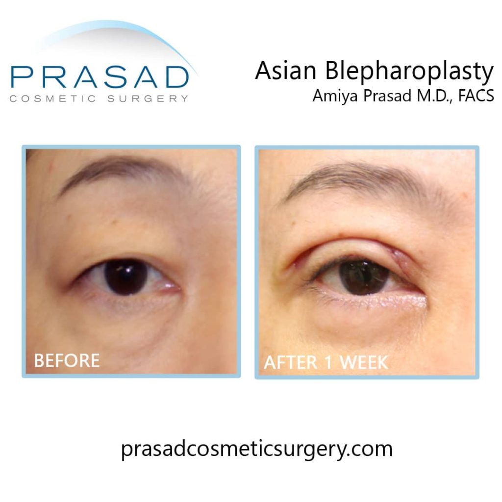 Eyelid surgery for asian eyes before and after 1 week recovery