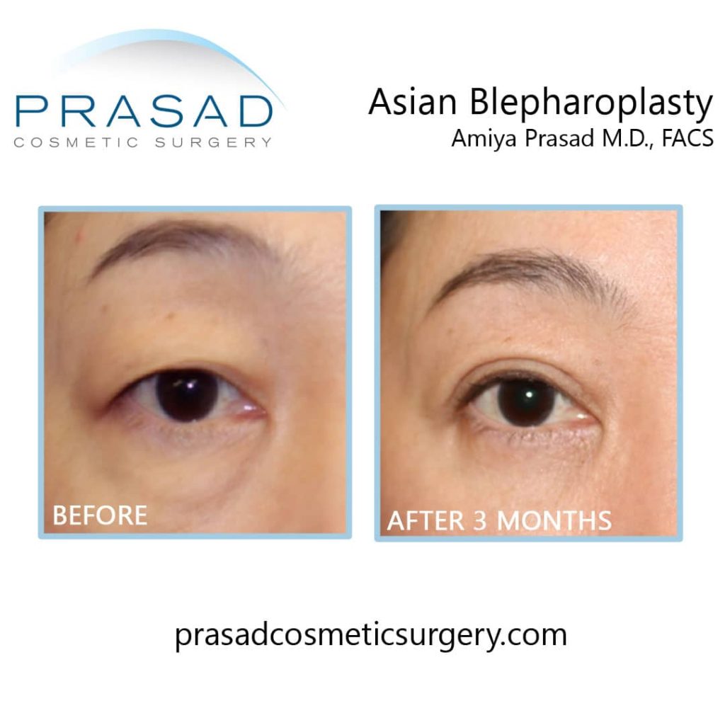 eyelid surgery for Asian eyes before and after 3 months recovery