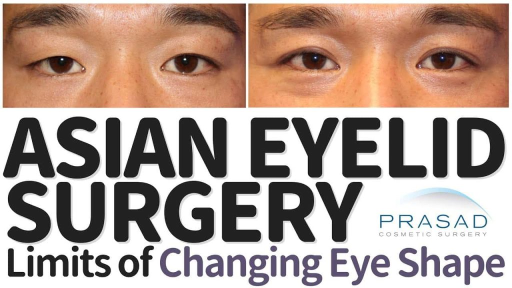 eyelid surgery for Asian eyes - limits of changing eye shape