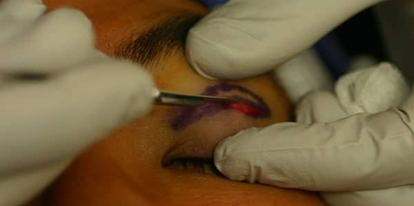 Asian eyelid surgery with incision being made